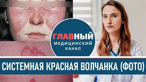 Автоиммунные заболевания: системная красная волчанка