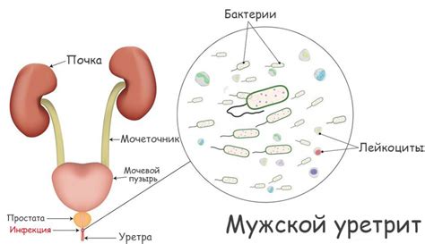 Аллергии и уретрит