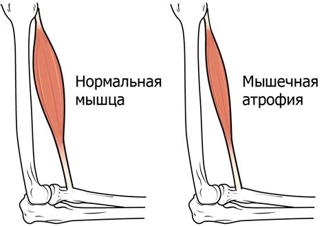 Атрофия мышц