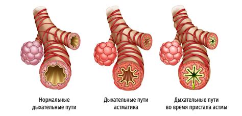 Бета блокаторы и бронхиальная астма: потенциальные проблемы