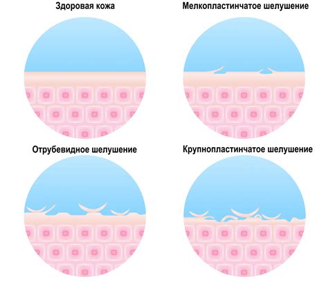 Болезни, вызывающие шелушение и грубость кожи ног