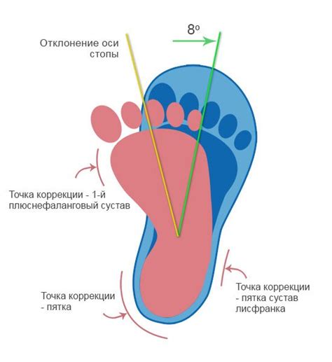 Валгусная деформация стопы