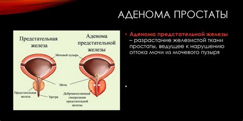 Влияние заболеваний предстательной железы на работу мочевого пузыря