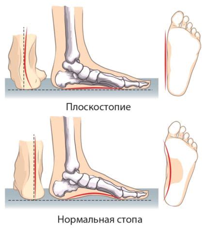 Возможные причины боли на сгибе стопы