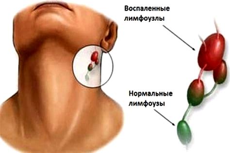 Возможные причины воспаления лимфоузлов на шее и под мышками