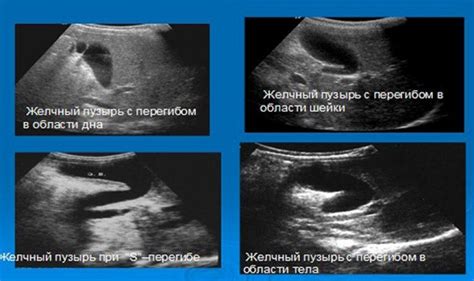 Возможные причины перегиба желчного пузыря у ребенка