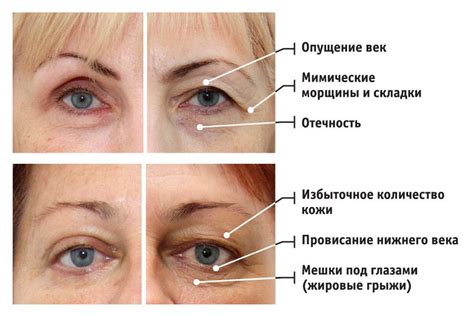 Возрастные изменения и мешки под глазами после инъекций ботокса