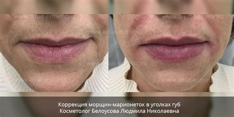 Возрастные изменения и морщины в уголках губ