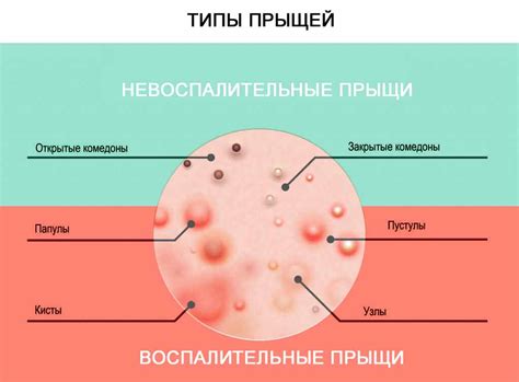 Воспаление вокруг прыщей