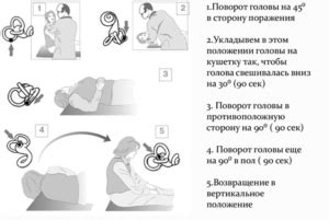 Головокружение при повороте: основные причины