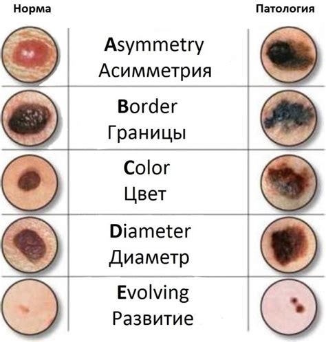 Гормональные изменения и выпуклые родинки