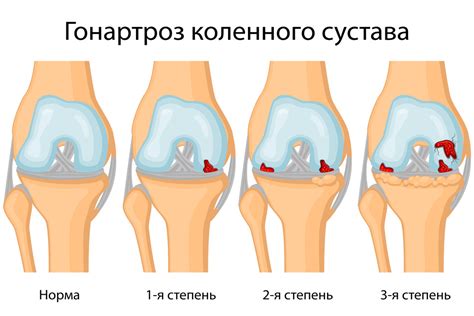 Деформирующий остеоартрит