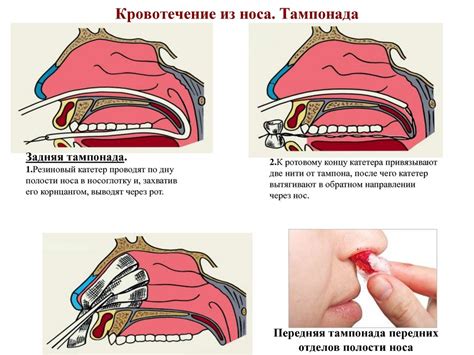 Дополнительные меры для остановки крови из носа