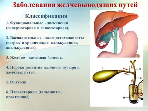 Заболевания желчного пузыря