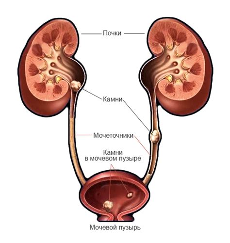 Заболевания мочевой системы