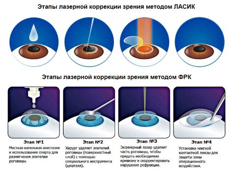 Заторможенная фокусировка после лазерной коррекции зрения