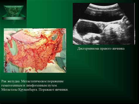 Злокачественные опухоли пищеварительной системы