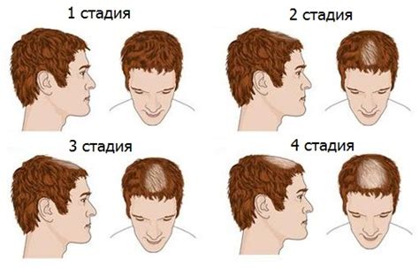 Избыток мужских гормонов и облысение