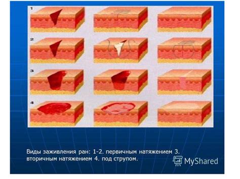 Инфекция раны