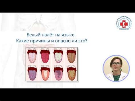 Какие различные причины белого языка существуют?