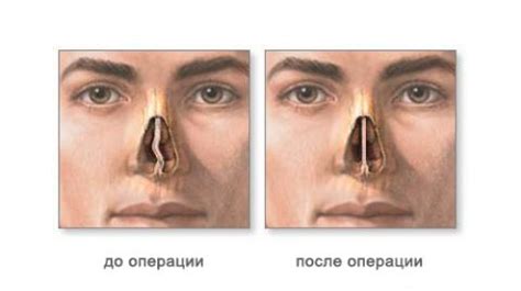 Какие способы лечения слезотечения после операции на нос существуют?