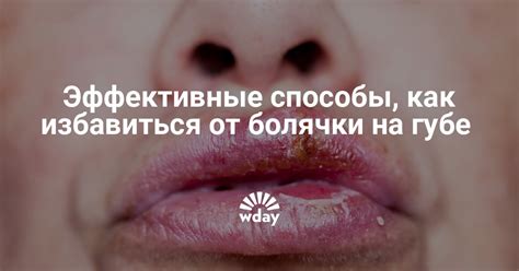 Как избавиться от зуда верхней губы?