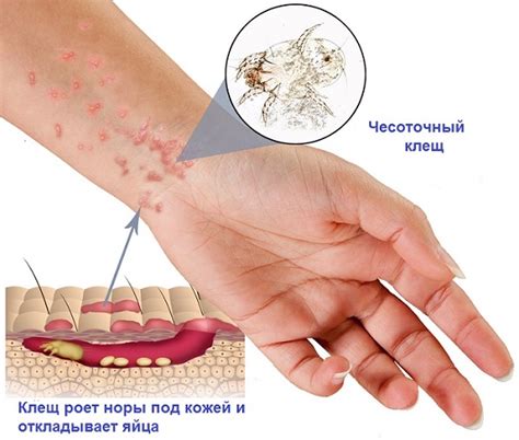 Как обнаружить наличие чесоточного клеща