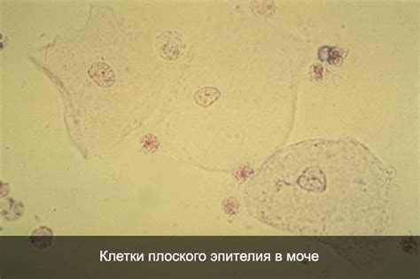 Как определить повышенное содержание плоского эпителия в моче у мужчин?