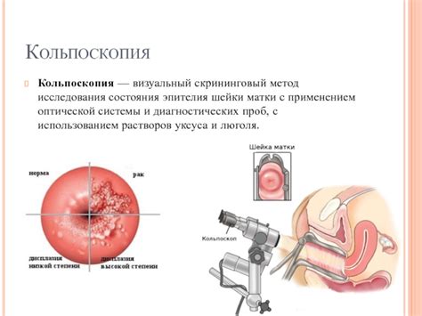 Кольпоскопия: определение и цели исследования