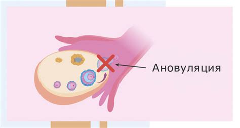 Медицинские причины отсутствия овуляции