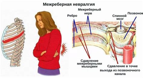 Межреберная невралгия