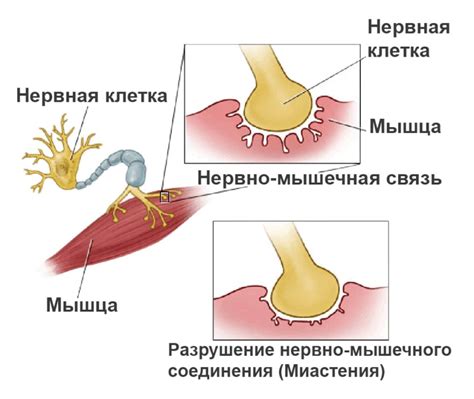 Мышечная слабость: миастения