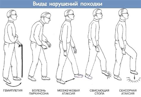 Нарушение естественной походки