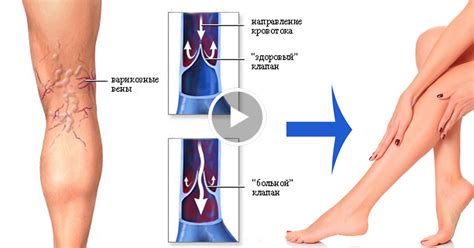 Нарушение кровообращения и варикозное расширение вен