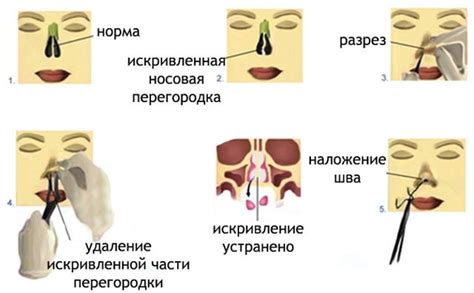 Нарушения формирования носовой перегородки