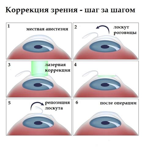 Неправильная коррекция зрения