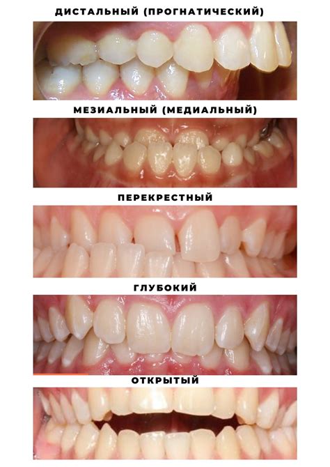 Неправильный прикус