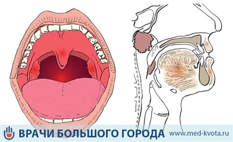 Неразвитие голосовых связок в ранних стадиях развития