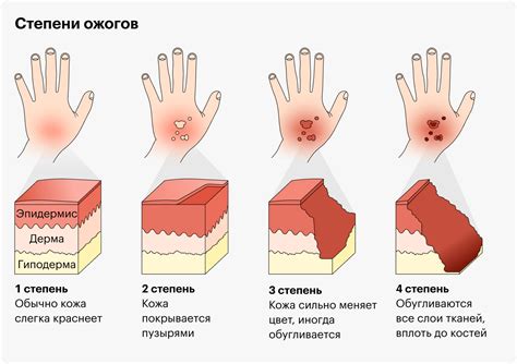 Ожог или травма