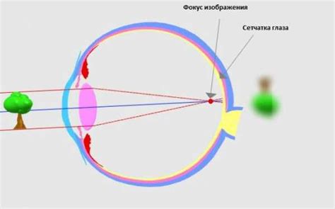 Определение близорукости и её симптомы