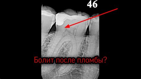 Оптимальное время ожидания после постановки пломбы