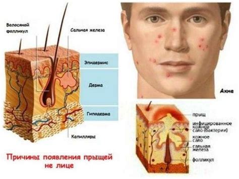 Основные причины появления красных прыщиков на лице у младенцев