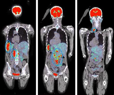 Особенности процедуры ПЭТ-КТ всего тела