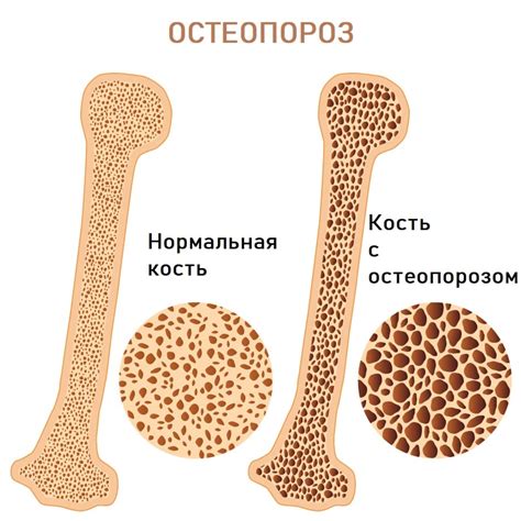 Остеопороз и снижение плотности костей