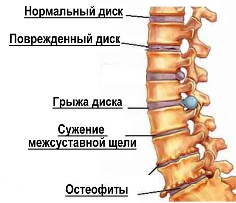 Остеохондроз позвоночника и его связь с болями в ногах