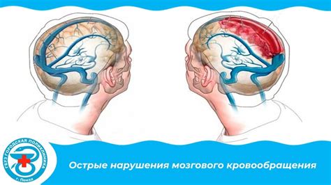 Острые нарушения мозгового кровообращения