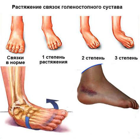 Отек голеностопа после растяжения связок: норма или сигнал проблемы?