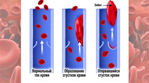 Отложенные кровяные сгустки