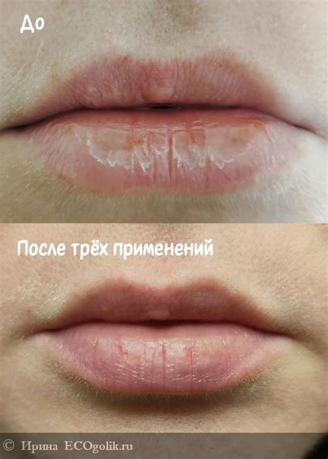 Плохая привычка облизывать губы