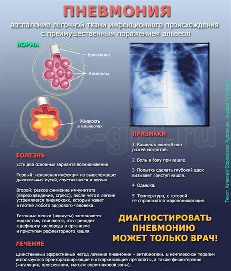 Пневмония и воспаление легких